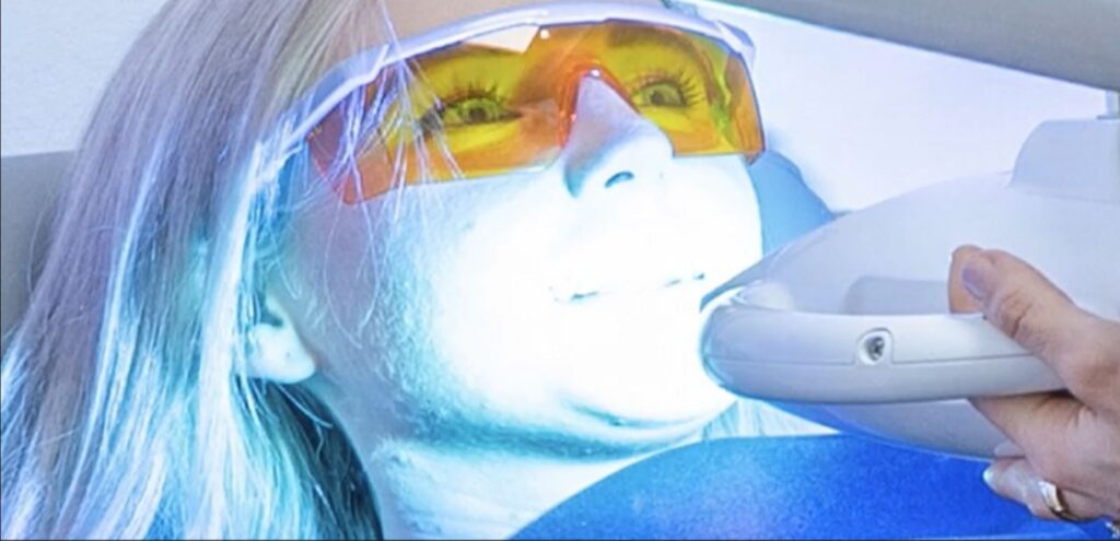 Top Teeth Whitening Treatment Dublin.