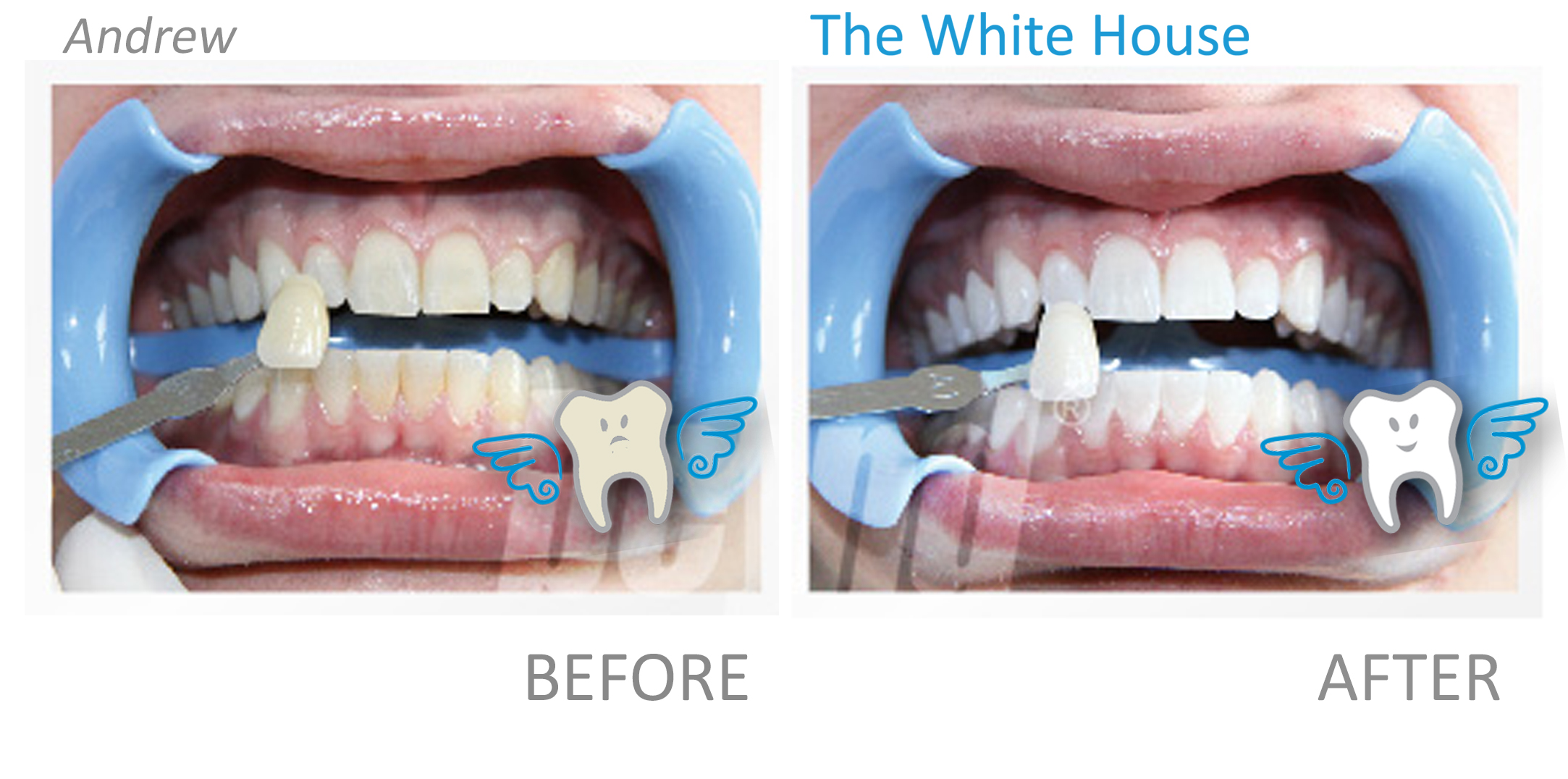 Teeth Whitening Before and Afte - Andrew