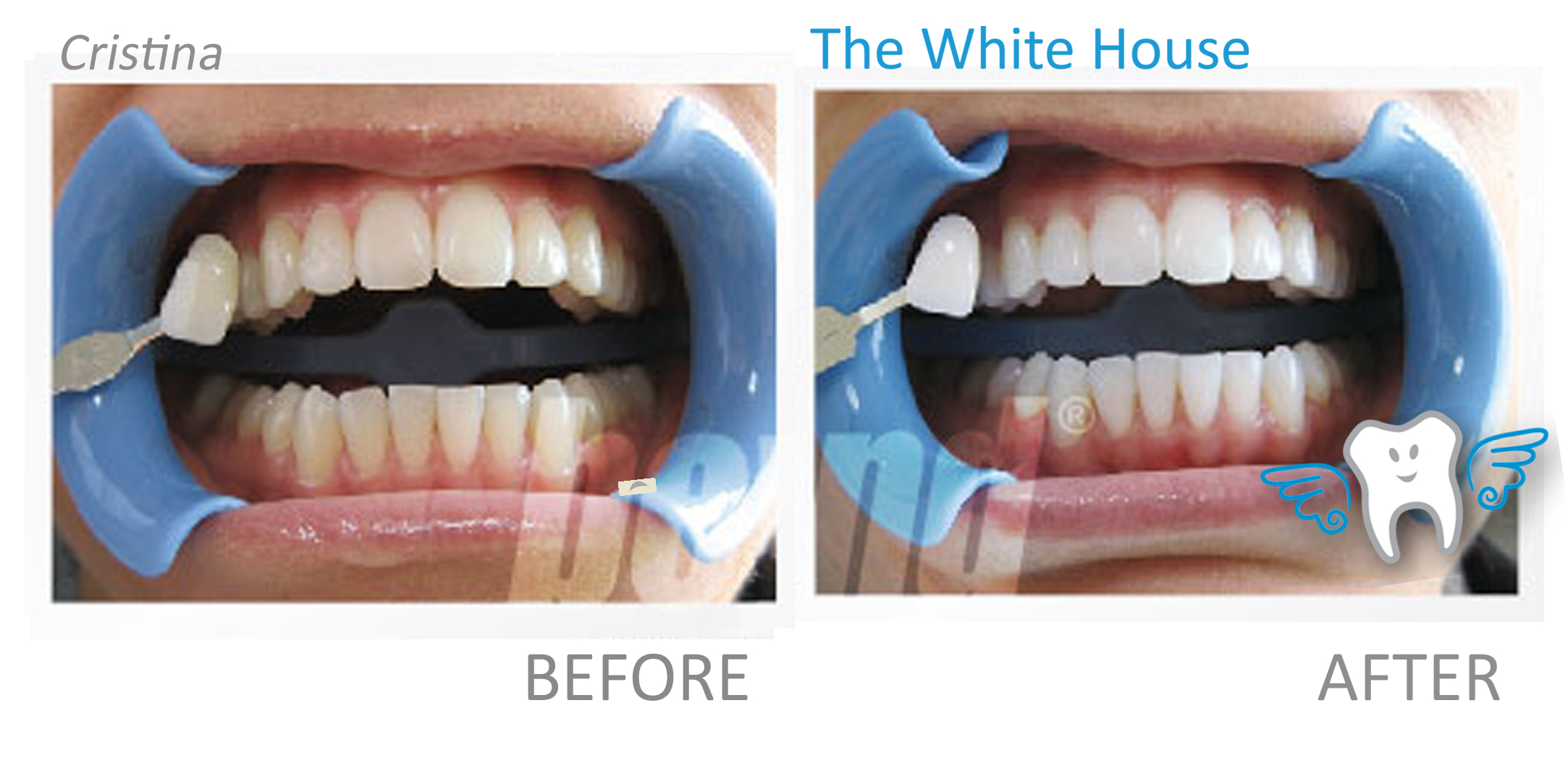 Teeth Whitening Before and Afte - Christin