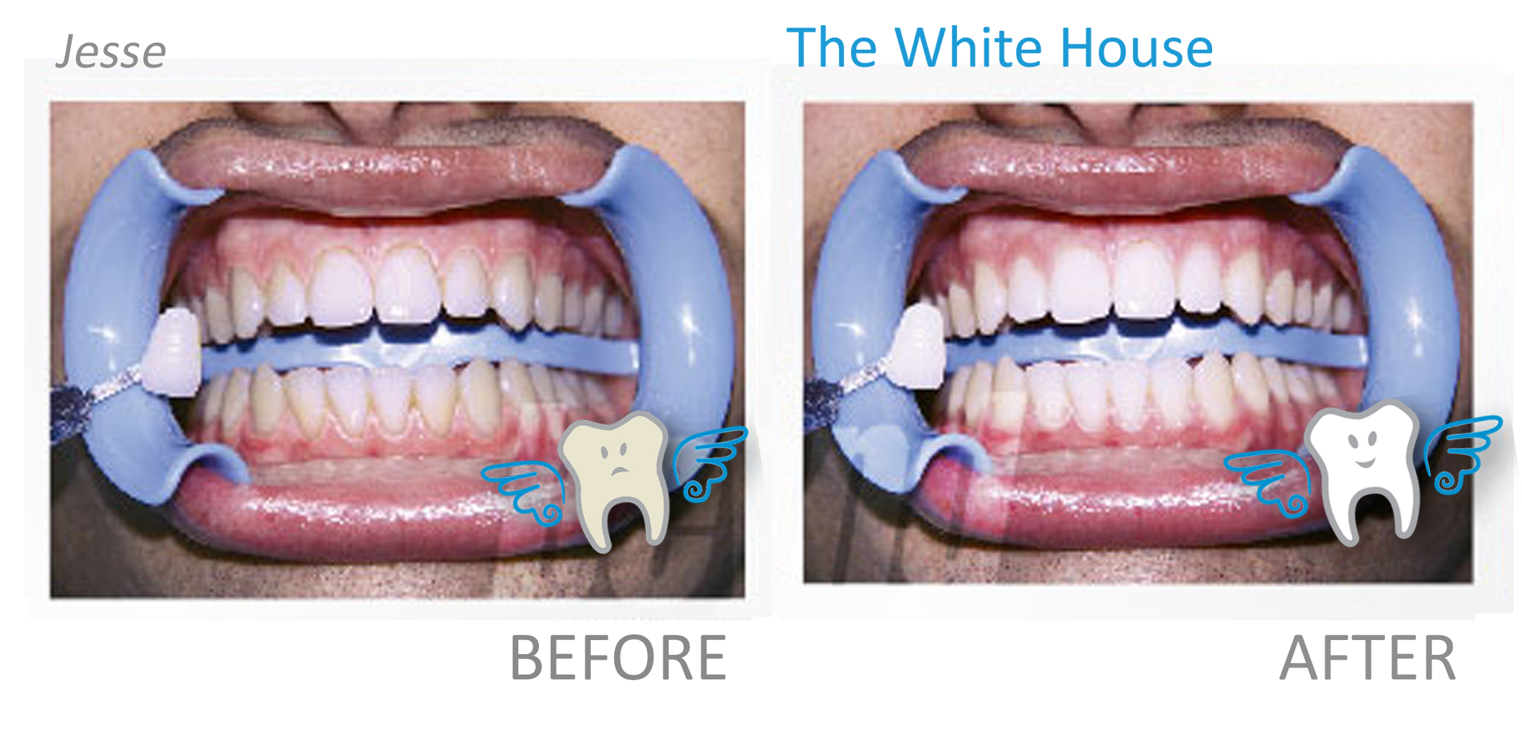 Teeth Whitening Before and Afte - Jesse