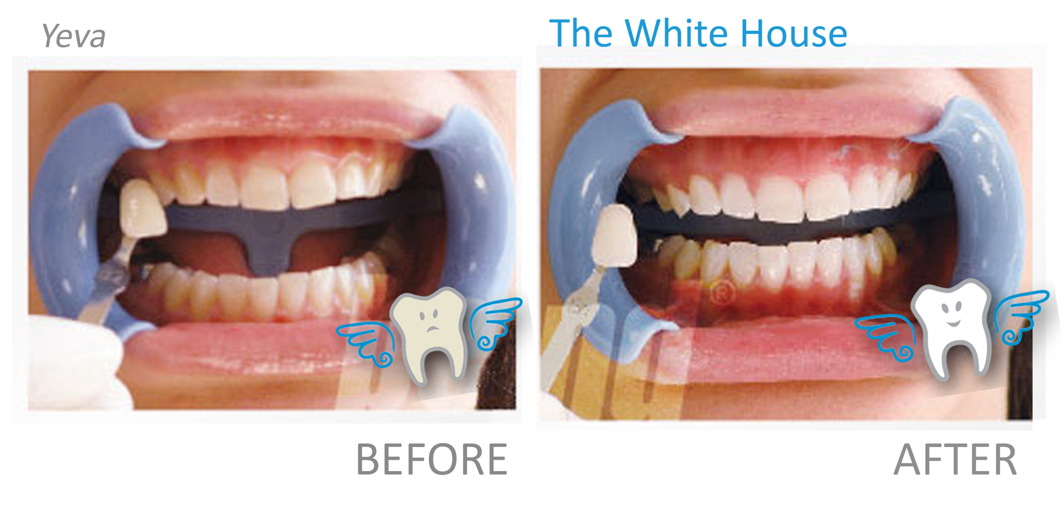 Teeth Whitening Before and Afte - Yeva